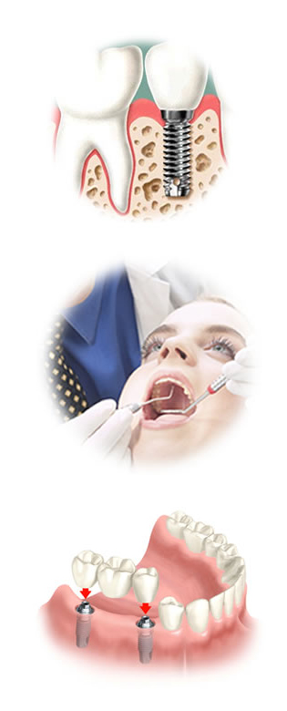 Tipos de Próteses e Implantes Dentário no Centro de SP 